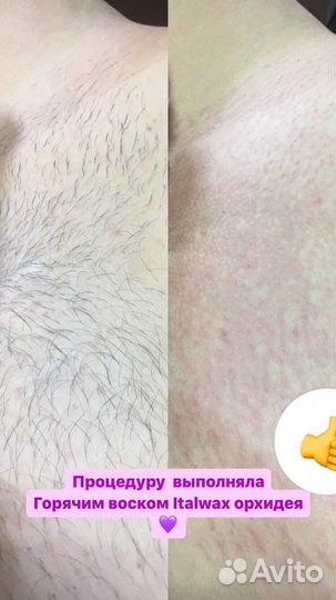 Восковая депиляция