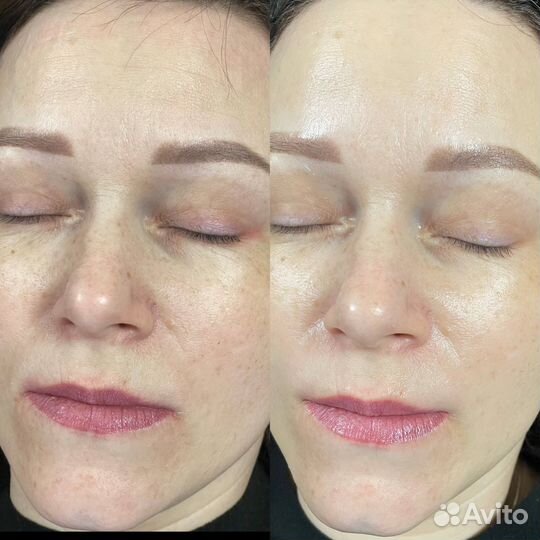 Ферментотеоапия FlaxEnzyme