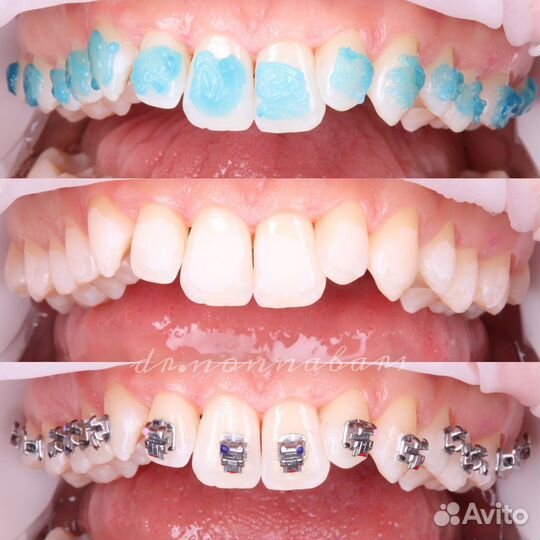 Выравнивание зубов брекеты спб
