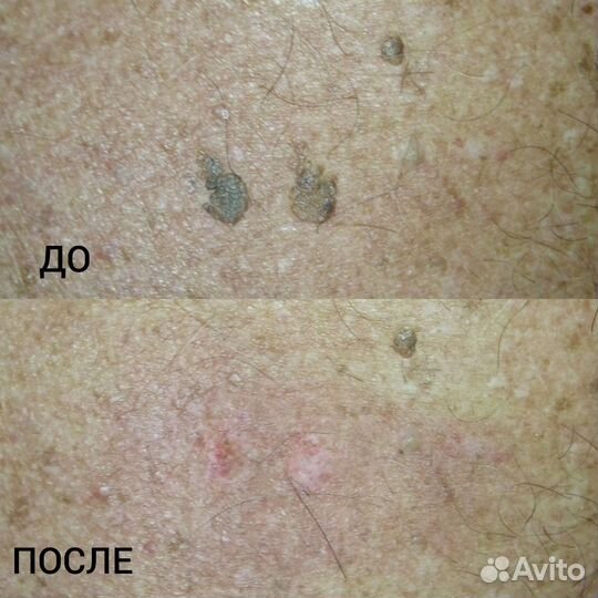 Лазерное удаление родинок, папиллом, бородавок