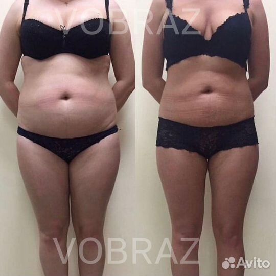 Аппаратная коррекция фигуры (программы похудения)