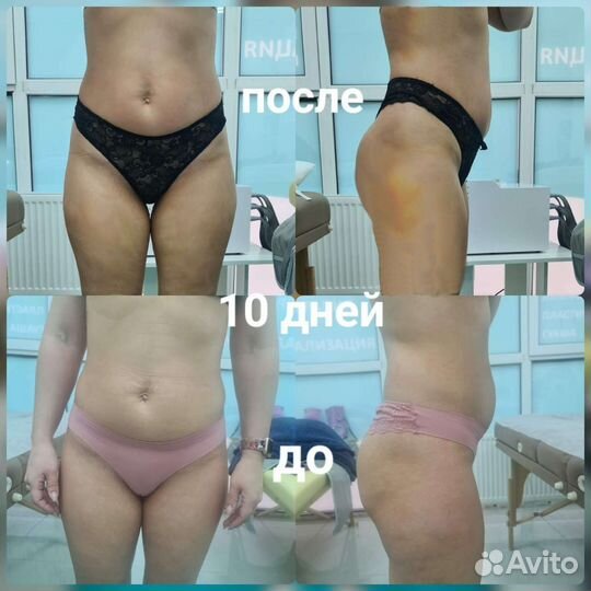 Похудение, коррекция фигуры