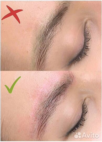 Удаление татуажа ремувером