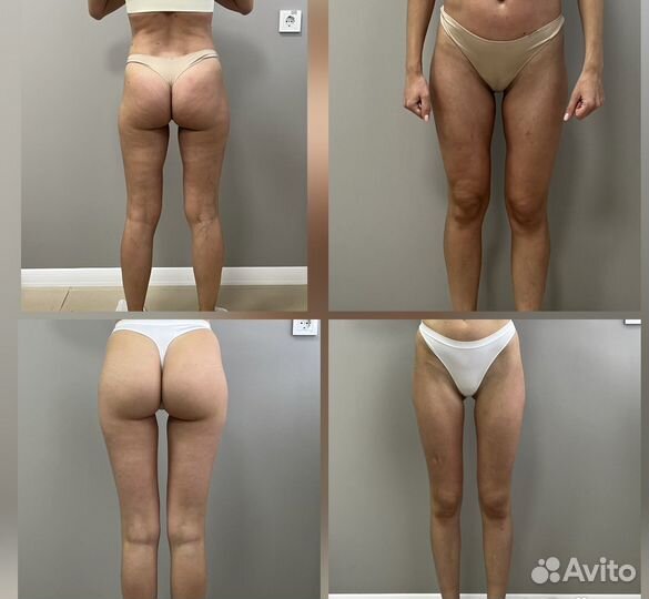 Антицеллюлитный массаж