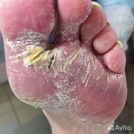 Мастер педикюра, подолог.Трещины,мозоли