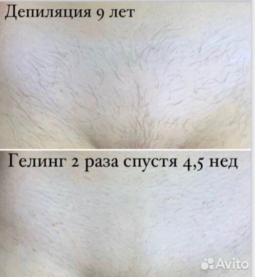 Гелинг депиляция