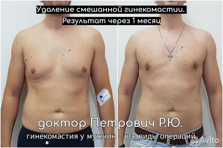 Лечение гинекомастии смешанной формы