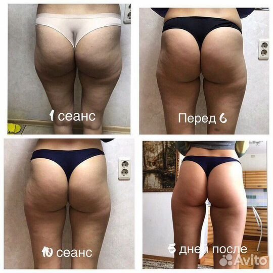 Антицеллюлитный массаж, массаж лица. Эффект сразу