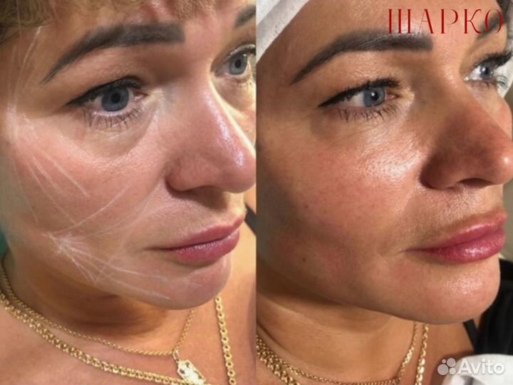 SMAS лифтинг / СМАС лифтинг