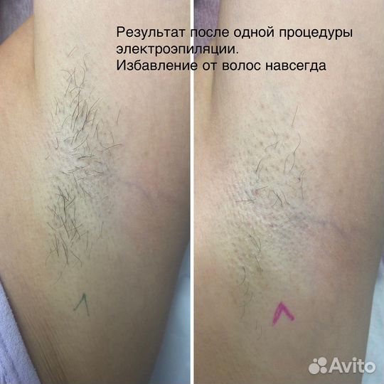 Электроэпиляция, принимаю женщин и мужчин