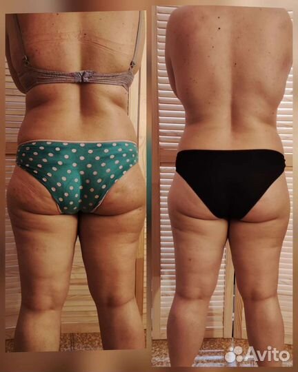 Антицеллюлитный массаж