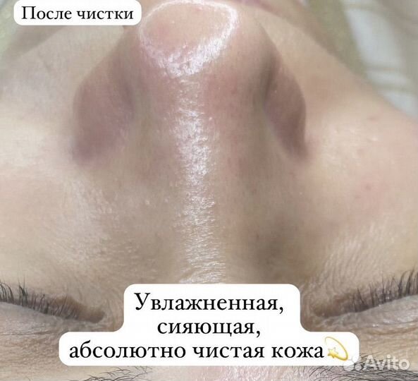 Чистка лица