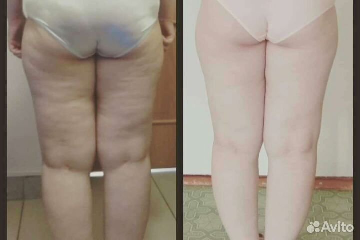 Массаж LPG, кавитация, скульптурный массаж лица