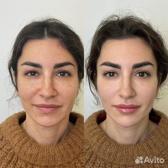 Контурная пластика лица.Full Face.Профиль Джоли