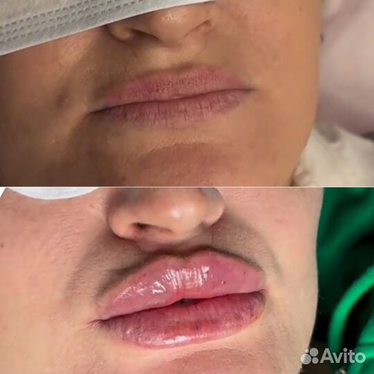 Увеличение губ