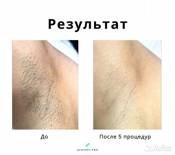 Диодный лазер Lumines Макс’Ван 1200 Вт