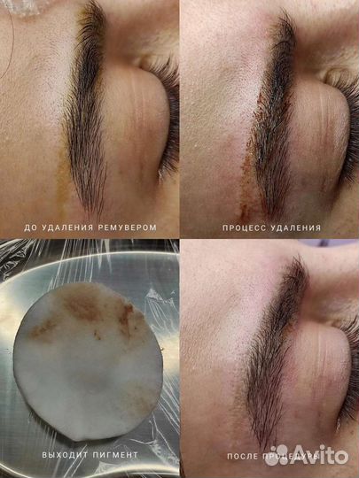 Удаление татуажа и татуировок