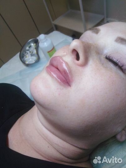 Увеличение губ,Ботокс,Липолитик,Биоревитализация