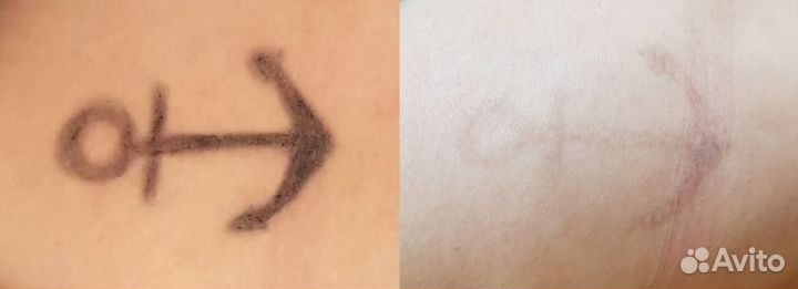 Лазерное удаление тату и татуажа