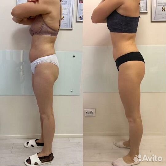 Коррекция фигуры (LPG, вакуум, RF, кавитация)