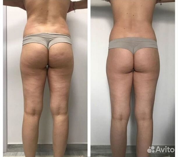 Вакуумный массаж, кавитация