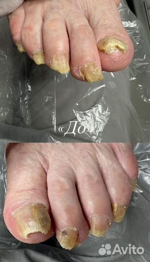 Педикюр подолог