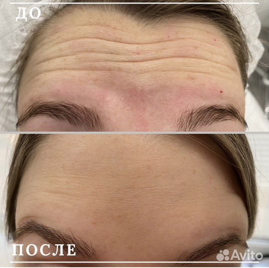 Ботулинотерапия