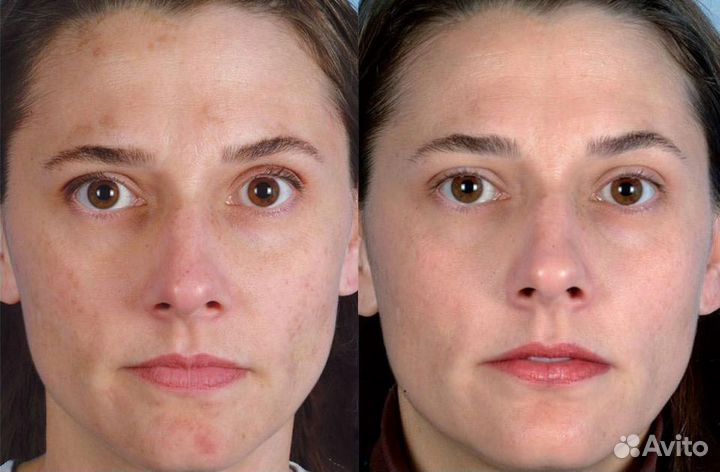 Модели на Криомассаж лица бесплатно