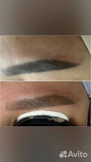 Лазерное удаление татуажа бровей