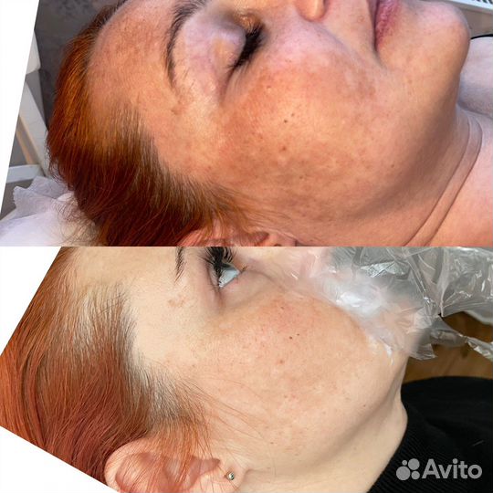 Нужны модели на процедуры по косметологии