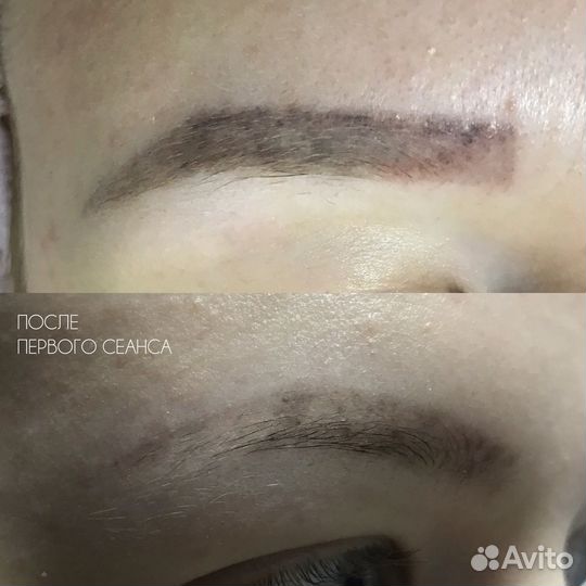 Модели на лазерное удаление татуажа бровей