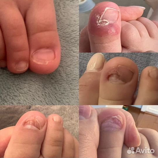 Подологичей педикюр