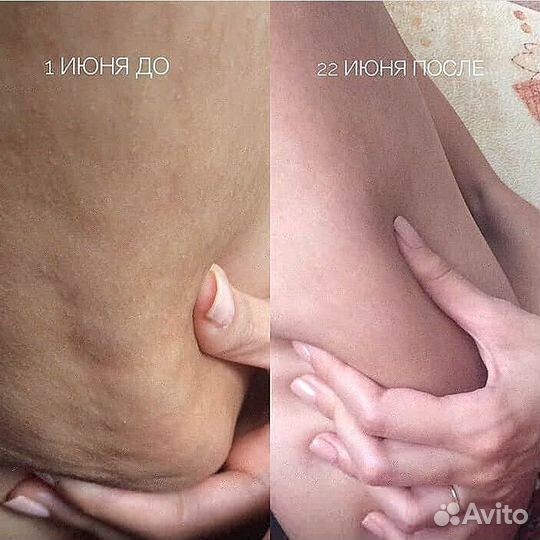 Антицеллюлитный гель