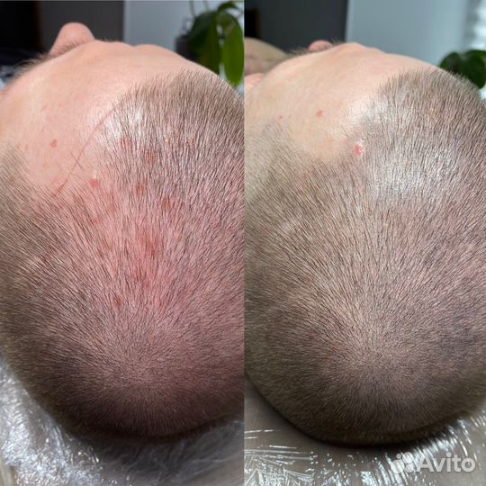 Трихопигментация для мужчин и женщин