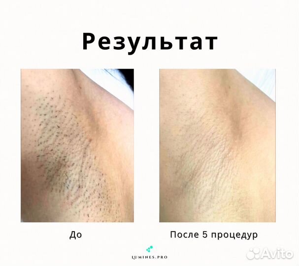 Диодный лазер для эпиляции Lumines Макс Ван 1200в