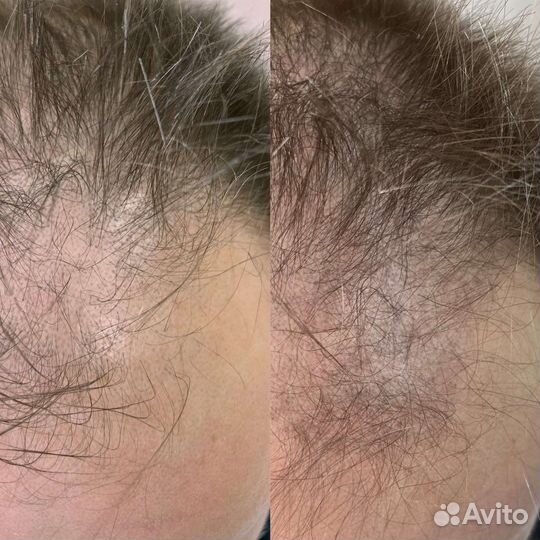 Трихопигментация головы