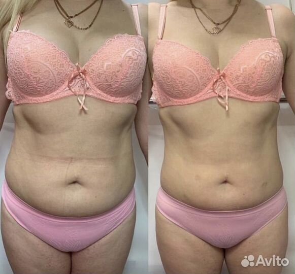 Модель на криолиполиз быстрое похудение