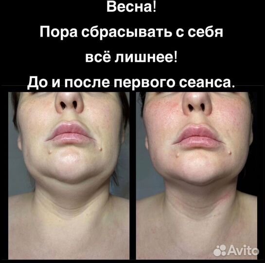 Массаж лица с результатом как после инъекций