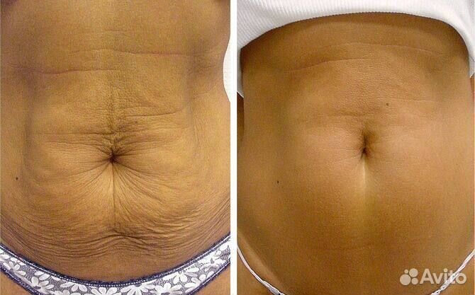 Щетка для сухого массажа