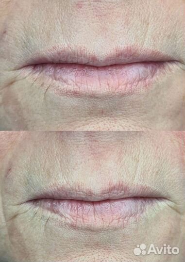 Удаление татуажа лазером