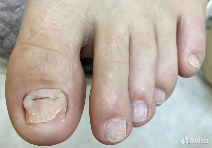 Установка титановой нити