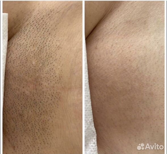 Лазерная эпиляция: голени