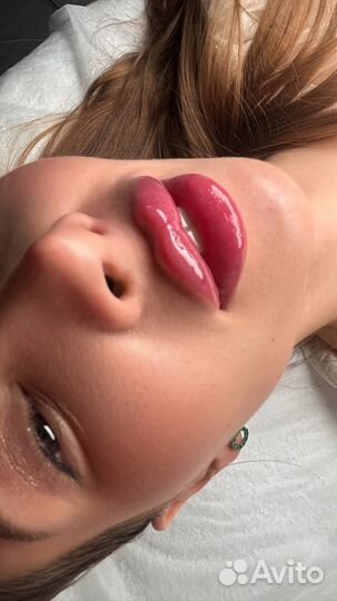 Увеличение губ, контурная пластика. Высший уровень