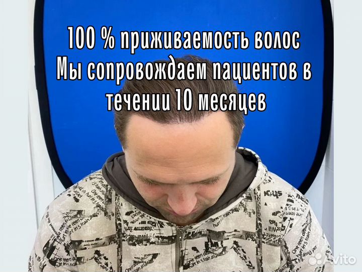 Пересадка волос для мужчин