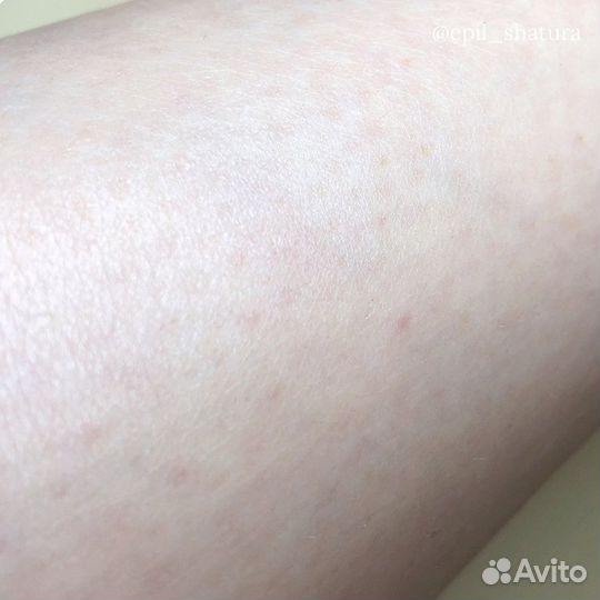 Электроэпиляция