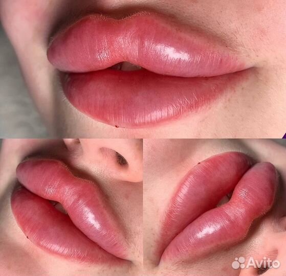 Исправление асимметрии губ