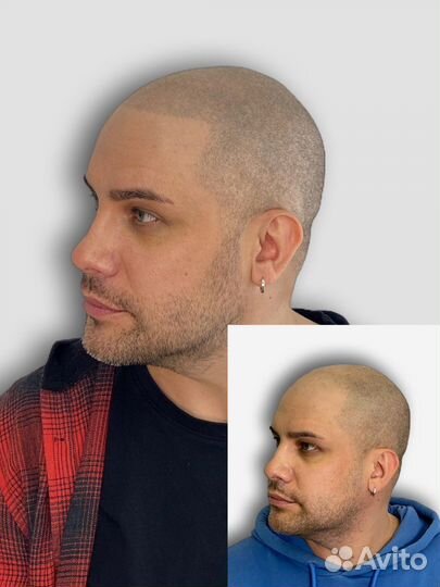 Трихопигментация головы