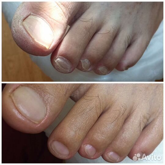 Медицинский педикюр/подолог