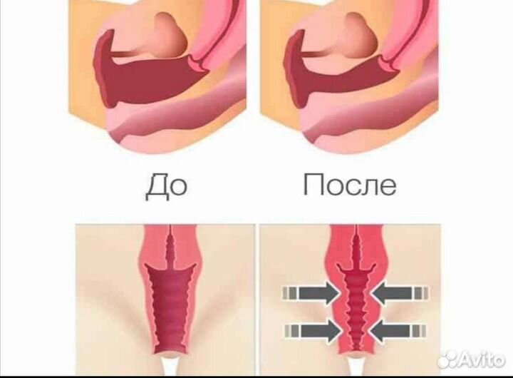 Сужение влагалища и лечение недержания мочи