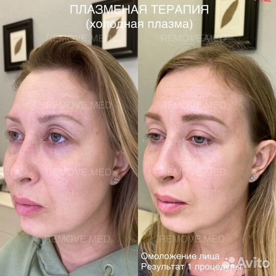 Холодная плазма процедуры обучение